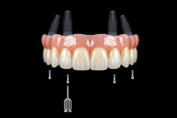 All On   Is A Minimally Invasive Solution For Missing Teeth