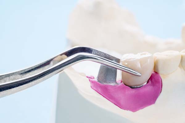Dental Implant Restoration Morton, PA