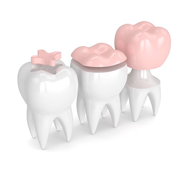 Morton Dental Inlays and Onlays
