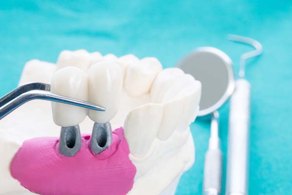 How Many Implants Are Needed For Upper Implant Supported Dentures?