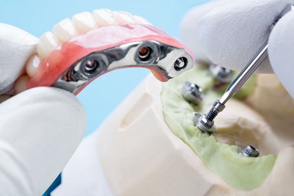 Tooth Replacement    : A Guide To Implant Supported Dentures
